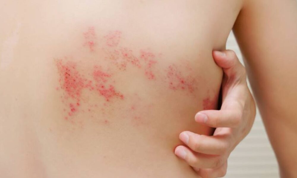 ds herpes