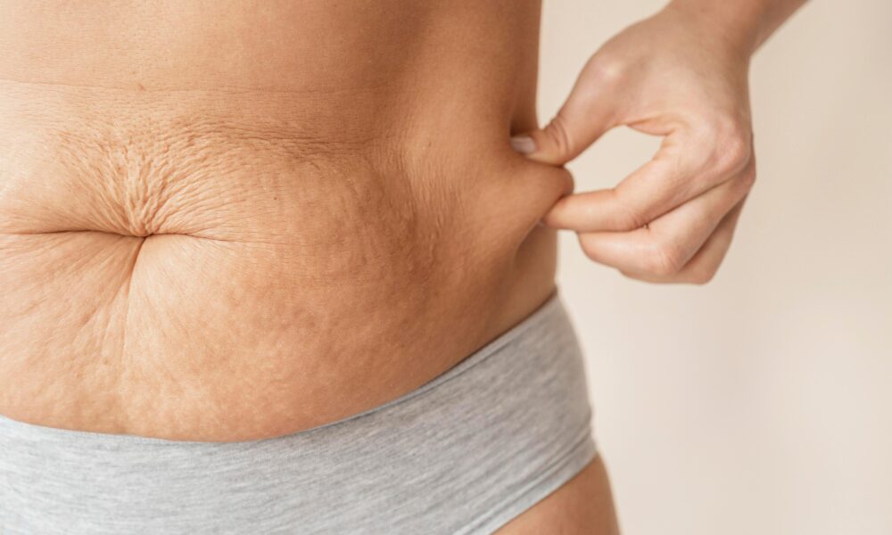 flacidez abdominal