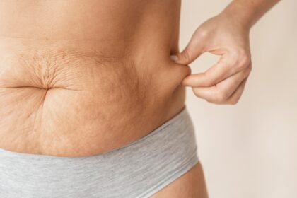 flacidez abdominal