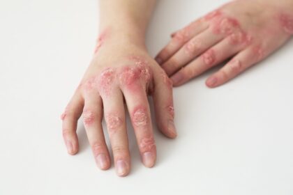 u psoriasis